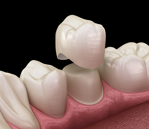 Illustration of a dental crown being fitted over a tooth