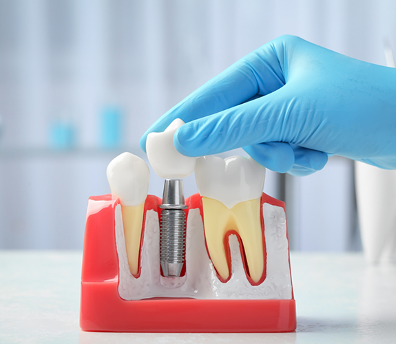 Dentist placing a crown over a model of a dental implant