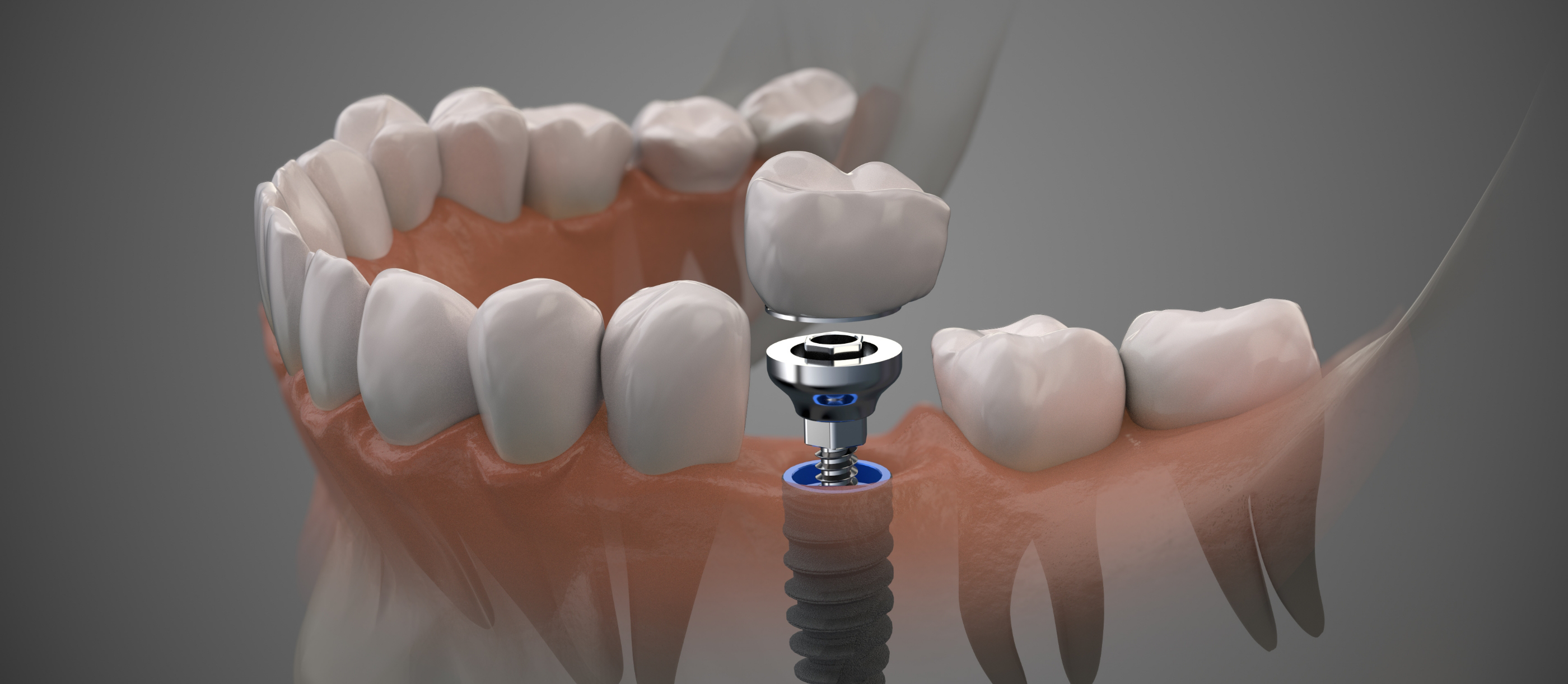 Illustration of a dental implant in Boynton Beach replacing a missing lower tooth