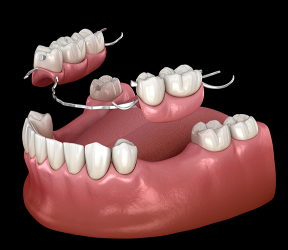 Illustration of a partial denture replacing several missing teeth along an arch