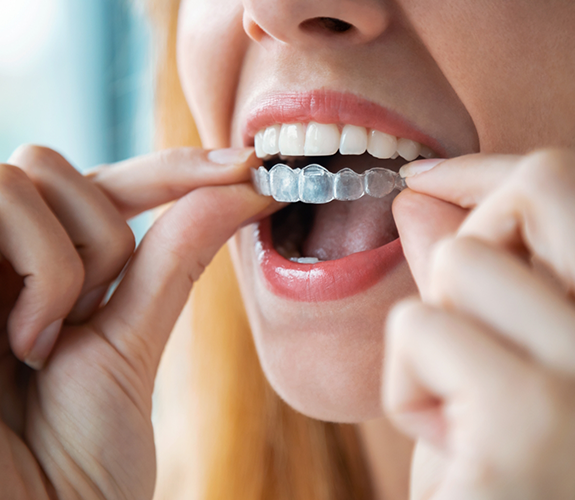 Close up of a woman placing an Invisalign aligner over her teeth