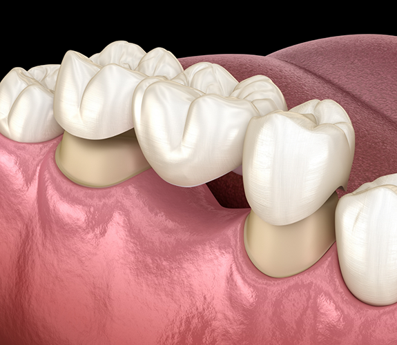 Illustrated dental bridge being fitted over two teeth to replace the missing tooth between them