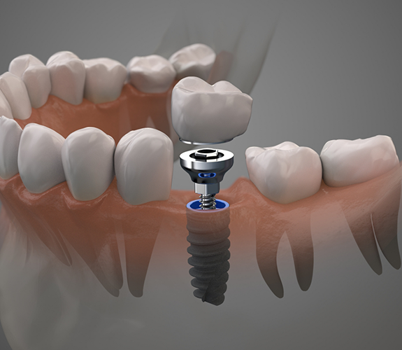 Illustration of a dental implant replacing a missing lower tooth