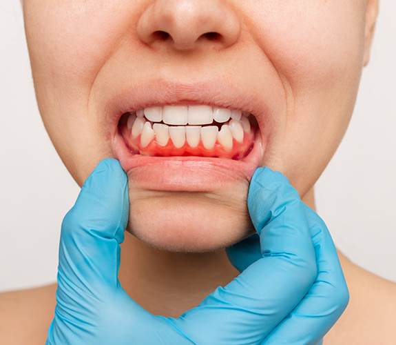 Close up of mouth with red gums