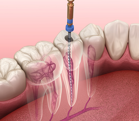 Illustration of a dental instrument treating the inside of a tooth