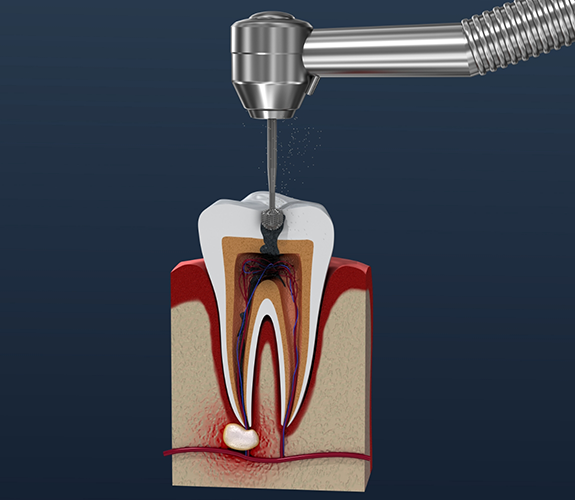 Illustrated dental instrument performing root canal treatment