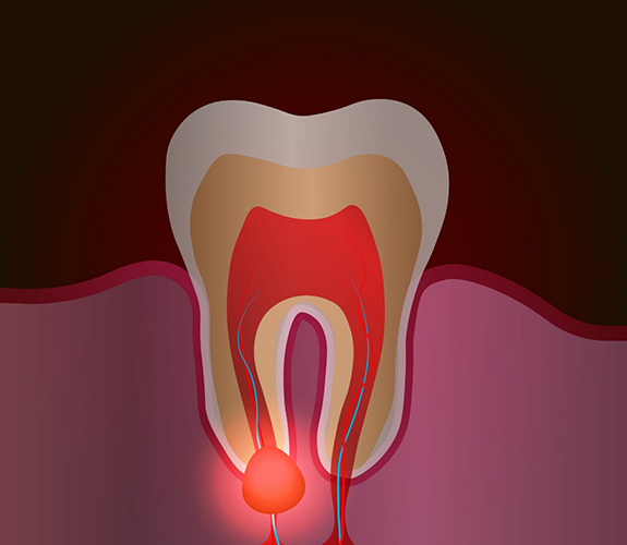 Illustrated tooth with a bump on the gums near the root