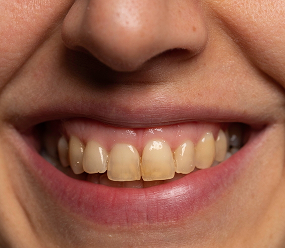 Close up of a smile with discolored teeth