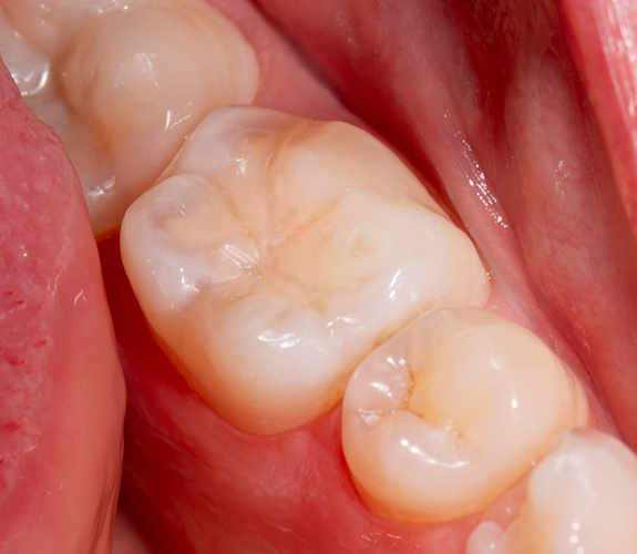 Close up of teeth with barely noticeable white fillings