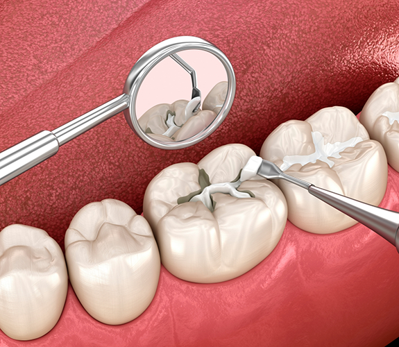 Illustration of a white filling being placed on a tooth