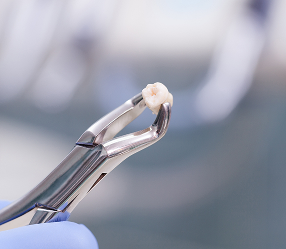 Dental clasp holding an extracted tooth